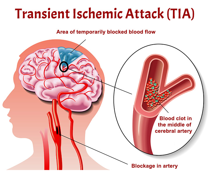 TIA (Transient Ischemic Attack): Symptoms & Treatment