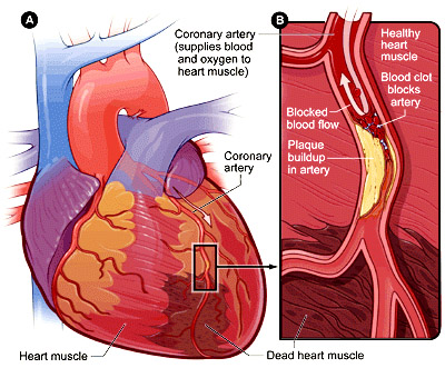 Angioplasty and stent placement - heart: MedlinePlus Medical