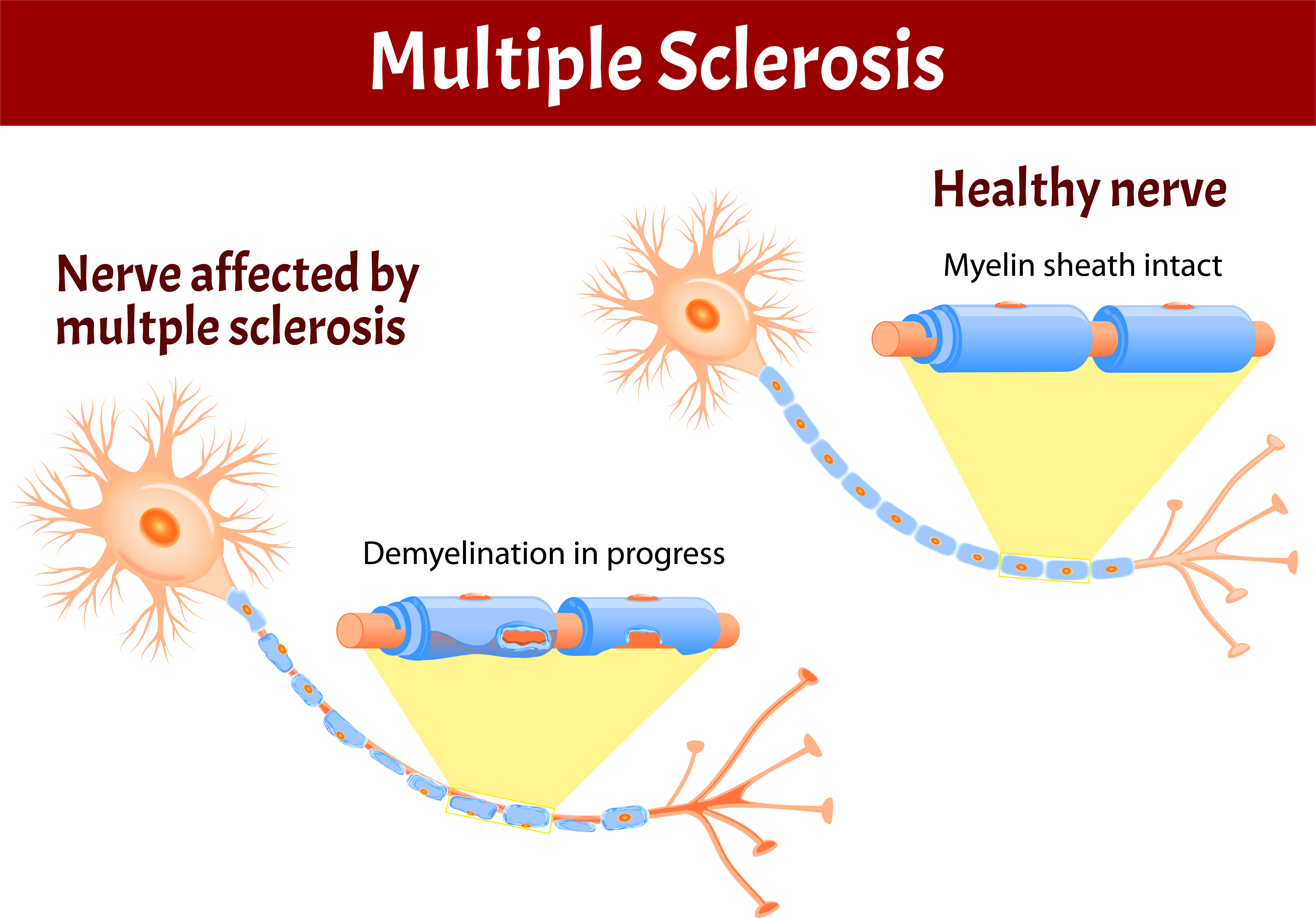 Multiple Sclerosis Aps Foundation Of America Inc