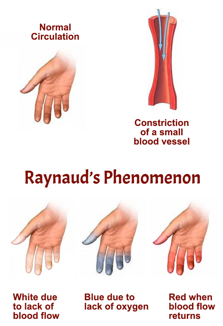Raynauds Phenomenon Aps Foundation Of America Inc
