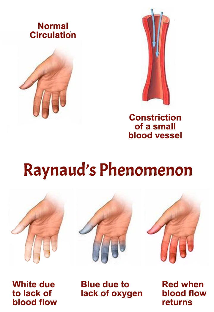 Raynaud's Phenomenon | APS Foundation of America, Inc.